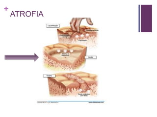 +
ATROFIA
 