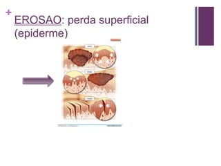 +
EROSAO: perda superficial
(epiderme)
 