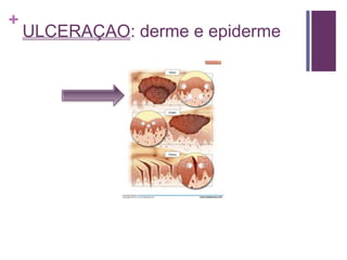 +
ULCERAÇAO: derme e epiderme
 
