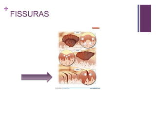 +
FISSURAS
 