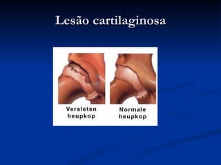 Lesão cartilaginosa 