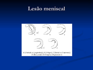 Lesão meniscal 