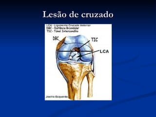 Lesão de cruzado 