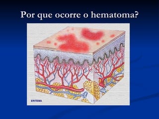 Por que ocorre o hematoma? 