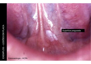 Estomatologia - HCPA
EXEMPLOS
–
LESÕES
EM
PLACA
Superfície pregueada
 