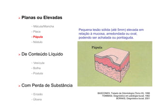 Planas ou Elevadas
- Mácula/Mancha
- Placa
- Pápula
- Nódulo
 De Conteúdo Líquido
- Vesícula
- Bolha
- Pústula
 Com Perda de Substância
- Erosão
- Úlcera
Pequena lesão sólida (até 5mm) elevada em
relação à mucosa, arredondada ou oval,
podendo ser achatada ou pontiaguda.
BASCONES, Tratado de Odontología (Tomo III), 1998
TOMMASI, Diagnóstico em patologia bucal, 1982
BORAKS, Diagnóstico bucal, 2001
 