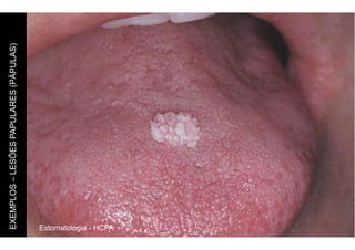 Estomatologia - HCPA
EXEMPLOS
–
LESÕES
PAPULARES
(PÀPULAS)
 