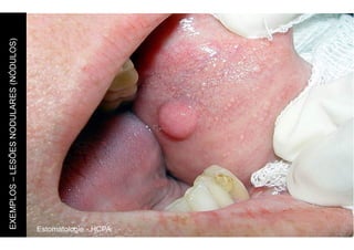 Estomatologia - HCPA
EXEMPLOS
–
LESÕES
NODULARES
(NÓDULOS)
 