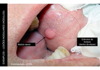 Estomatologia - HCPA
EXEMPLOS
–
LESÕES
NODULARES
(NÓDULOS)
Nódulo séssil
Grânulos de
fordyce
(dentro da elipse)
 