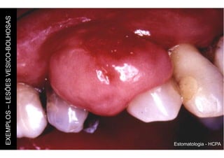 Estomatologia - HCPA
EXEMPLOS
–
LESÕES
VESICO-BOLHOSAS
 