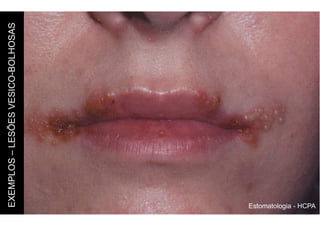 Estomatologia - HCPA
EXEMPLOS
–
LESÕES
VESICO-BOLHOSAS
 