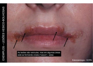 Estomatologia - HCPA
EXEMPLOS
–
LESÕES
VESICO-BOLHOSAS
As lesões são vesículas, mas em algumas áreas
está se formando crosta (“casca”) - setas
 