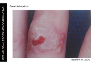 Panarício herpético
Neville et al. (2004)
EXEMPLOS
–
LESÕES
VESICO-BOLHOSAS
 
