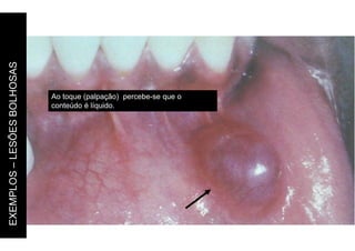 Neville et al. (2004)
EXEMPLOS
–
LESÕES
BOLHOSAS
Ao toque (palpação) percebe-se que o
conteúdo é líquido.
 