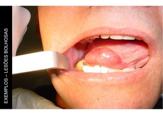 EXEMPLOS
–
LESÕES
BOLHOSAS
 