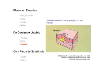 Planas ou Elevadas
- Mácula/Mancha
- Placa
- Pápula
- Nódulo
 De Conteúdo Líquido
- Vesícula
- Bolha
- Pústula
 Com Perda de Substância
- Erosão
- Úlcera
Vesícula ou bolha com supuração no seu
interior.
BASCONES, Tratado de Odontología (Tomo III), 1998
TOMMASI, Diagnóstico em patologia bucal, 1982
BORAKS, Diagnóstico bucal, 2001
 