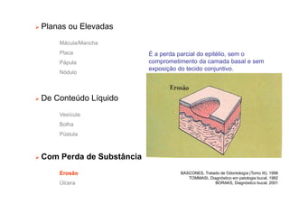 Planas ou Elevadas
Mácula/Mancha
Placa
Pápula
Nódulo
 De Conteúdo Líquido
Vesícula
Bolha
Pústula
 Com Perda de Substância
Erosão
Úlcera
É a perda parcial do epitélio, sem o
comprometimento da camada basal e sem
exposição do tecido conjuntivo.
BASCONES, Tratado de Odontología (Tomo III), 1998
TOMMASI, Diagnóstico em patologia bucal, 1982
BORAKS, Diagnóstico bucal, 2001
 