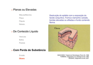 Planas ou Elevadas
Mácula/Mancha
Placa
Pápula
Nódulo
 De Conteúdo Líquido
Vesícula
Bolha
Pústula
 Com Perda de Substância
Erosão
Úlcera
Destruição do epitélio com a exposição do
tecido conjuntivo. Forma e tamanho variado,
bordas elevadas ou afiladas e fundo contendo
fibrina.
BASCONES, Tratado de Odontología (Tomo III), 1998
TOMMASI, Diagnóstico em patologia bucal, 1982
BORAKS, Diagnóstico bucal, 2001
 