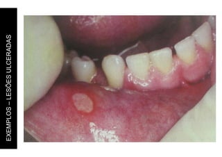 EXEMPLOS
–
LESÕES
ULCERADAS
 