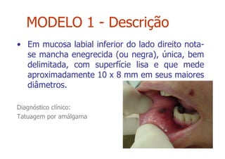 • Em mucosa labial inferior do lado direito nota-
se mancha enegrecida (ou negra), única, bem
delimitada, com superfície lisa e que mede
aproximadamente 10 x 8 mm em seus maiores
diâmetros.
Diagnóstico clínico:
Tatuagem por amálgama
MODELO 1 - Descrição
 
