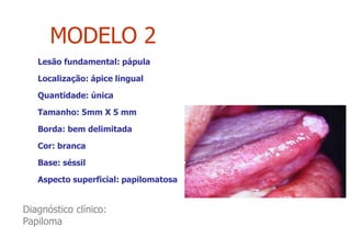 MODELO 2
Lesão fundamental: pápula
Localização: ápice lingual
Quantidade: única
Tamanho: 5mm X 5 mm
Borda: bem delimitada
Cor: branca
Base: séssil
Aspecto superficial: papilomatosa
Diagnóstico clínico:
Papiloma
 