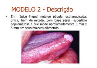 • Em ápice lingual nota-se pápula, esbranquiçada,
única, bem delimitada, com base séssil, superfície
papilomatosa e que mede aproximadamente 5 mm x
5 mm em seus maiores diâmetros.
MODELO 2 - Descrição
 