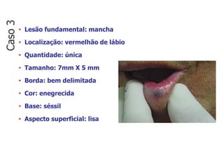 • Lesão fundamental: mancha
• Localização: vermelhão de lábio
• Quantidade: única
• Tamanho: 7mm X 5 mm
• Borda: bem delimitada
• Cor: enegrecida
• Base: séssil
• Aspecto superficial: lisa
Caso
3
 