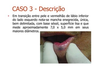 • Em transição entre pele e vermelhão de lábio inferior
do lado esquerdo nota-se mancha enegrecida, única,
bem delimitada, com base séssil, superfície lisa e que
mede aproximadamente 7,0 x 5,0 mm em seus
maiores diâmetros.
CASO 3 - Descrição
 