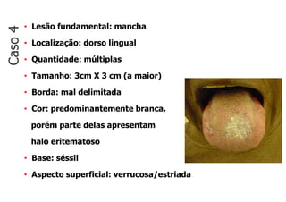 • Lesão fundamental: mancha
• Localização: dorso lingual
• Quantidade: múltiplas
• Tamanho: 3cm X 3 cm (a maior)
• Borda: mal delimitada
• Cor: predominantemente branca,
porém parte delas apresentam
halo eritematoso
• Base: séssil
• Aspecto superficial: verrucosa/estriada
Caso
4
 