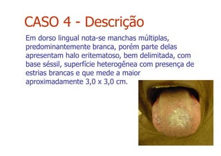 Em dorso lingual nota-se manchas múltiplas,
predominantemente branca, porém parte delas
apresentam halo eritematoso, bem delimitada, com
base séssil, superfície heterogênea com presença de
estrias brancas e que mede a maior
aproximadamente 3,0 x 3,0 cm.
CASO 4 - Descrição
 