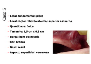 • Lesão fundamental: placa
• Localização: rebordo alveolar superior esquerdo
• Quantidade: única
• Tamanho: 1,5 cm x 0,8 cm
• Borda: bem delimitada
• Cor: branca
• Base: séssil
• Aspecto superficial: verrucosa
Caso
5
 