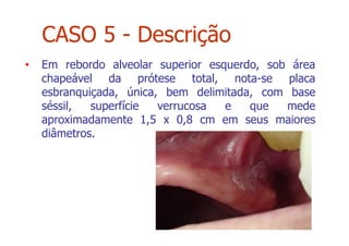 • Em rebordo alveolar superior esquerdo, sob área
chapeável da prótese total, nota-se placa
esbranquiçada, única, bem delimitada, com base
séssil, superfície verrucosa e que mede
aproximadamente 1,5 x 0,8 cm em seus maiores
diâmetros.
CASO 5 - Descrição
 