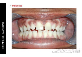 Hatch C.L. Pigmented lesions of the oral cavity.
Dental Clinics of North America, n.3, p. 185-201, 2005.
 Melanose
EXEMPLOS
–
MANCHAS
 