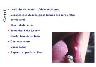 • Lesão fundamental: nódulo vegetante
• Localização: Mucosa jugal do lado esquerdo retro-
comissural
• Quantidade: única
• Tamanho: 5,0 x 3,0 mm
• Borda: bem delimitada
• Cor: rosa claro
• Base: séssil
• Aspecto superficial: lisa
Caso
6
 