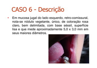 • Em mucosa jugal do lado esquerdo, retro-comissural,
nota-se nódulo vegetante, único, de coloração rosa
claro, bem delimitada, com base séssil, superfície
lisa e que mede aproximadamente 5,0 x 3,0 mm em
seus maiores diâmetros.
CASO 6 - Descrição
 