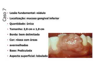 • Lesão fundamental: nódulo
• Localização: mucosa gengival inferior
• Quantidade: única
• Tamanho: 2,0 cm x 1,0 cm
• Borda: bem delimitada
• Cor: rósea com áreas
• avermelhadas
• Base: Pediculada
• Aspecto superficial: lobulado
Caso
7
 