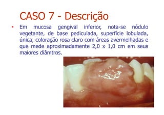 • Em mucosa gengival inferior, nota-se nódulo
vegetante, de base pediculada, superfície lobulada,
única, coloração rosa claro com áreas avermelhadas e
que mede aproximadamente 2,0 x 1,0 cm em seus
maiores diâmtros.
CASO 7 - Descrição
 