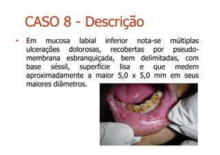 • Em mucosa labial inferior nota-se múltiplas
ulcerações dolorosas, recobertas por pseudo-
membrana esbranquiçada, bem delimitadas, com
base séssil, superfície lisa e que medem
aproximadamente a maior 5,0 x 5,0 mm em seus
maiores diâmetros.
CASO 8 - Descrição
 