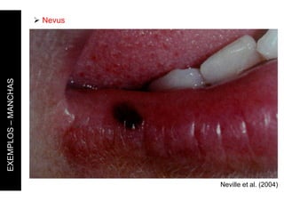Neville et al. (2004)
 Nevus
EXEMPLOS
–
MANCHAS
 