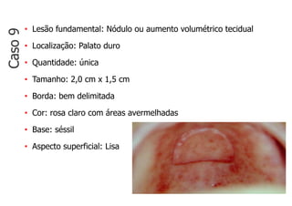 • Lesão fundamental: Nódulo ou aumento volumétrico tecidual
• Localização: Palato duro
• Quantidade: única
• Tamanho: 2,0 cm x 1,5 cm
• Borda: bem delimitada
• Cor: rosa claro com áreas avermelhadas
• Base: séssil
• Aspecto superficial: Lisa
Caso
9
 