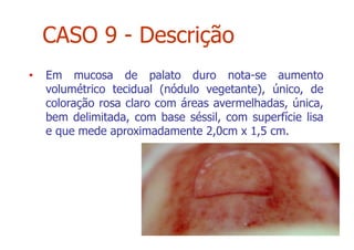 • Em mucosa de palato duro nota-se aumento
volumétrico tecidual (nódulo vegetante), único, de
coloração rosa claro com áreas avermelhadas, única,
bem delimitada, com base séssil, com superfície lisa
e que mede aproximadamente 2,0cm x 1,5 cm.
CASO 9 - Descrição
 