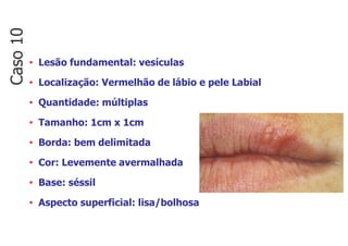 • Lesão fundamental: vesículas
• Localização: Vermelhão de lábio e pele Labial
• Quantidade: múltiplas
• Tamanho: 1cm x 1cm
• Borda: bem delimitada
• Cor: Levemente avermalhada
• Base: séssil
• Aspecto superficial: lisa/bolhosa
Caso
10
 