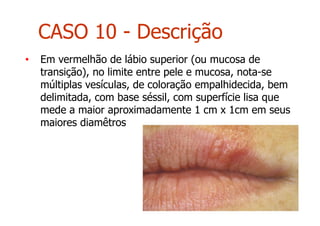 • Em vermelhão de lábio superior (ou mucosa de
transição), no limite entre pele e mucosa, nota-se
múltiplas vesículas, de coloração empalhidecida, bem
delimitada, com base séssil, com superfície lisa que
mede a maior aproximadamente 1 cm x 1cm em seus
maiores diamêtros
CASO 10 - Descrição
 
