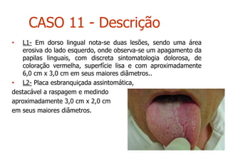 • L1- Em dorso lingual nota-se duas lesões, sendo uma área
erosiva do lado esquerdo, onde observa-se um apagamento da
papilas linguais, com discreta sintomatologia dolorosa, de
coloração vermelha, superfície lisa e com aproximadamente
6,0 cm x 3,0 cm em seus maiores diâmetros..
• L2- Placa esbranquiçada assintomática,
destacável a raspagem e medindo
aproximadamente 3,0 cm x 2,0 cm
em seus maiores diâmetros.
CASO 11 - Descrição
 