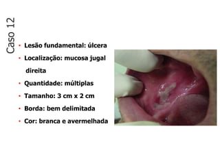 • Lesão fundamental: úlcera
• Localização: mucosa jugal
direita
• Quantidade: múltiplas
• Tamanho: 3 cm x 2 cm
• Borda: bem delimitada
• Cor: branca e avermelhada
Caso
12
 