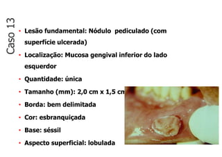 • Lesão fundamental: Nódulo pediculado (com
superfície ulcerada)
• Localização: Mucosa gengival inferior do lado
esquerdor
• Quantidade: única
• Tamanho (mm): 2,0 cm x 1,5 cm
• Borda: bem delimitada
• Cor: esbranquiçada
• Base: séssil
• Aspecto superficial: lobulada
Caso
13
 