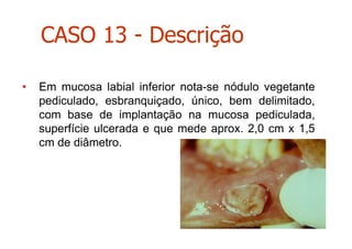 • Em mucosa labial inferior nota-se nódulo vegetante
pediculado, esbranquiçado, único, bem delimitado,
com base de implantação na mucosa pediculada,
superfície ulcerada e que mede aprox. 2,0 cm x 1,5
cm de diâmetro.
CASO 13 - Descrição
 