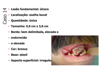 • Lesão fundamental: úlcera
• Localização: soalho bucal
• Quantidade: única
• Tamanho: 5,0 cm x 3,0 cm
• Borda: bem delimitada, elevada e
• endurecida
• e elevada
• Cor: branca
• Base: séssil
• Aspecto superficial: irregular
Caso
14
 