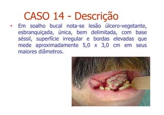 • Em soalho bucal nota-se lesão úlcero-vegetante,
esbranquiçada, única, bem delimitada, com base
séssil, superfície irregular e bordas elevadas que
mede aproximadamente 5,0 x 3,0 cm em seus
maiores diâmetros.
CASO 14 - Descrição
 