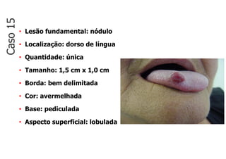 • Lesão fundamental: nódulo
• Localização: dorso de língua
• Quantidade: única
• Tamanho: 1,5 cm x 1,0 cm
• Borda: bem delimitada
• Cor: avermelhada
• Base: pediculada
• Aspecto superficial: lobulada
Caso
15
 
